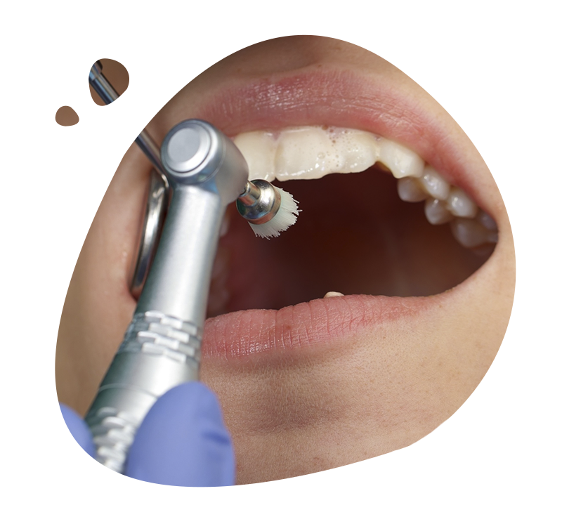 Diş Taşı Temizliği Dental Experts Oral and Dental Health Polyclinic